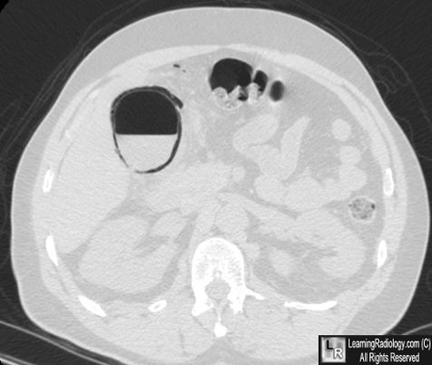 emphysematous cholecystitis